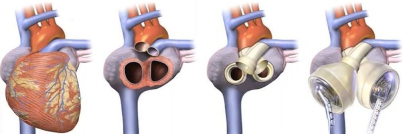 Medical Device Simulation & Compliance Support: SimuTech Blog