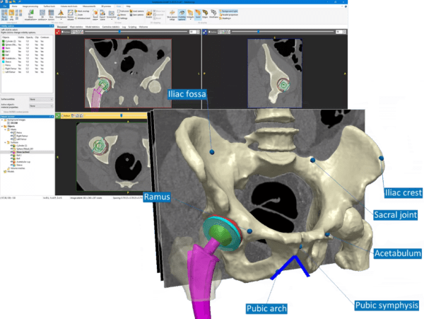 synopsys-simpleware-hip