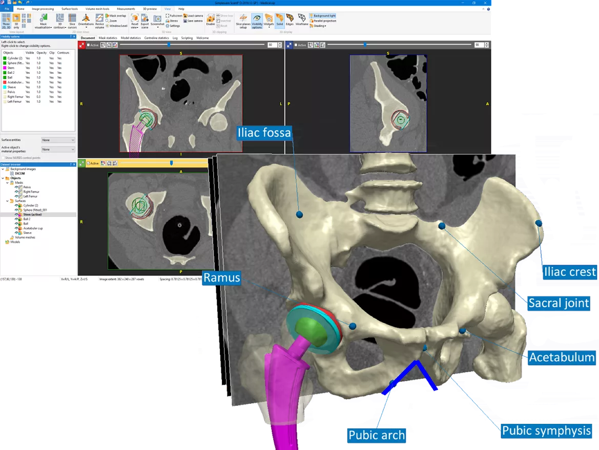 synopsys-simpleware-hip